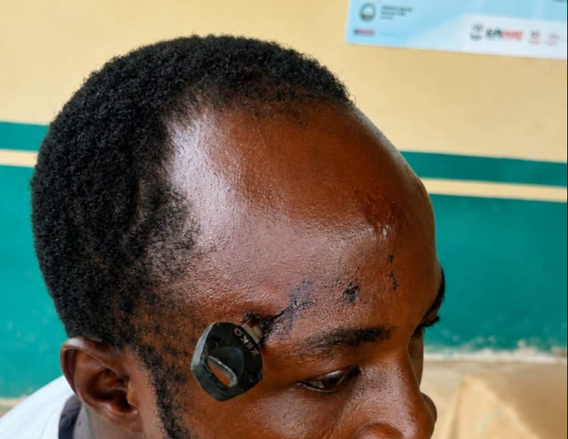 Doctors successfully remove motorbike key from farmer’s skull after Jasikan attack